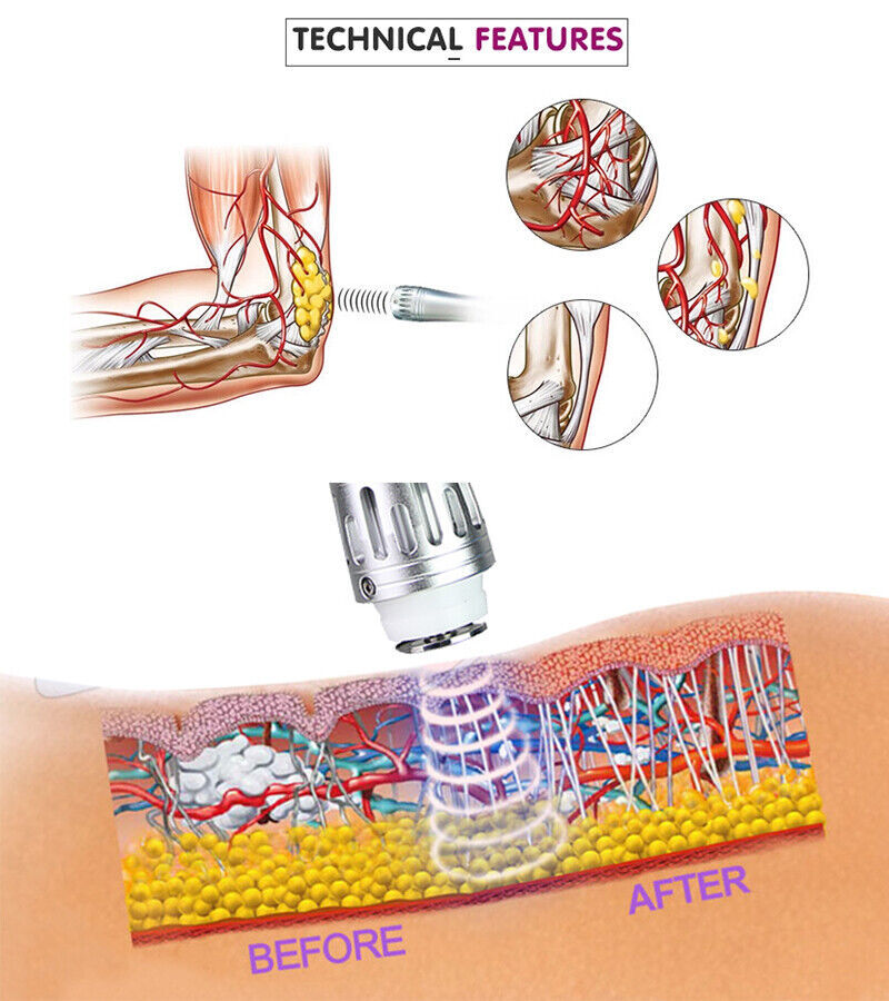ED Shockwave Therapy Machine Pain Removal For ED Erectile Dysfunction Treatment