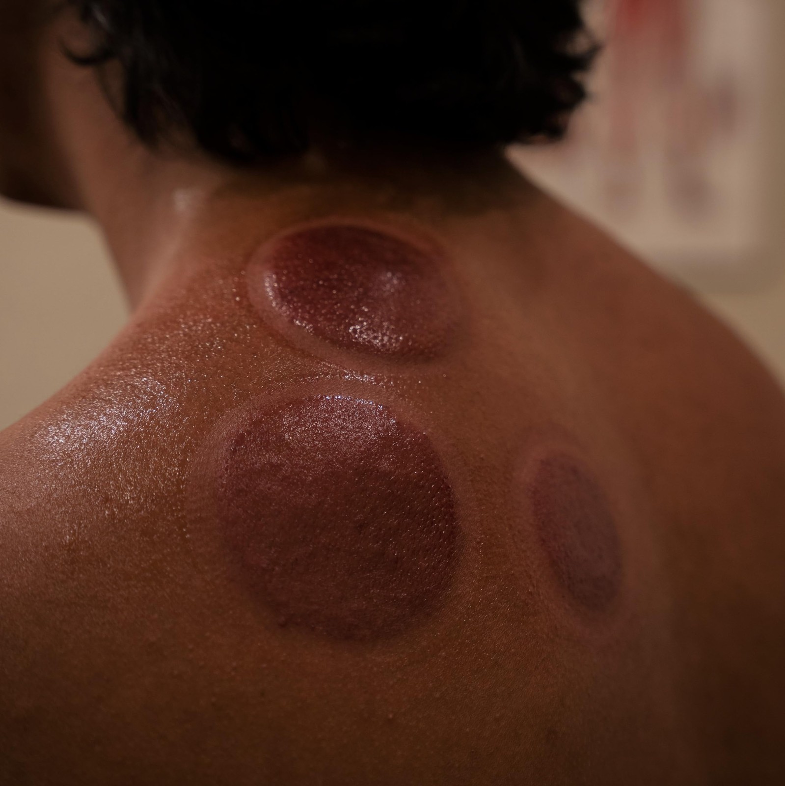 Myofascial Releaser Professional Cupping Therapy 1 Count (Pack of 1), Black