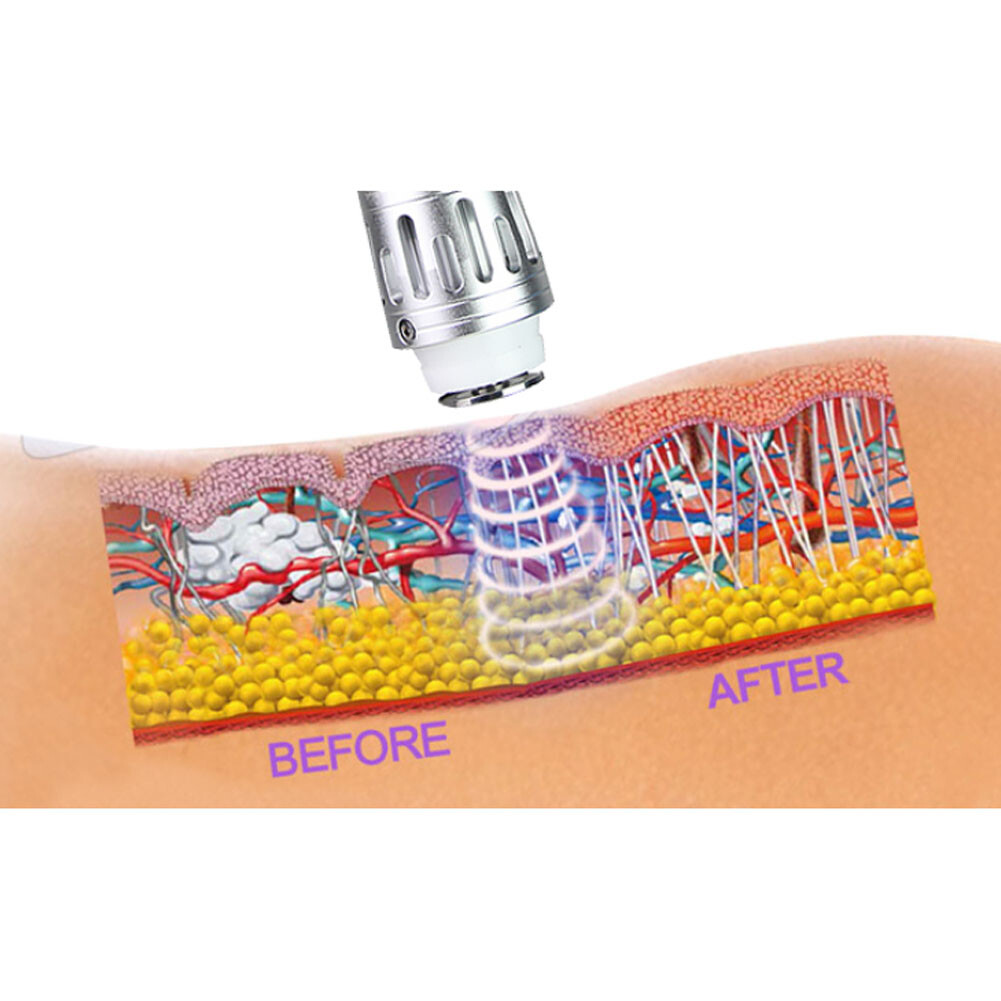110V Pain relief shock wave therapy equipment focused shockwave therapy machine